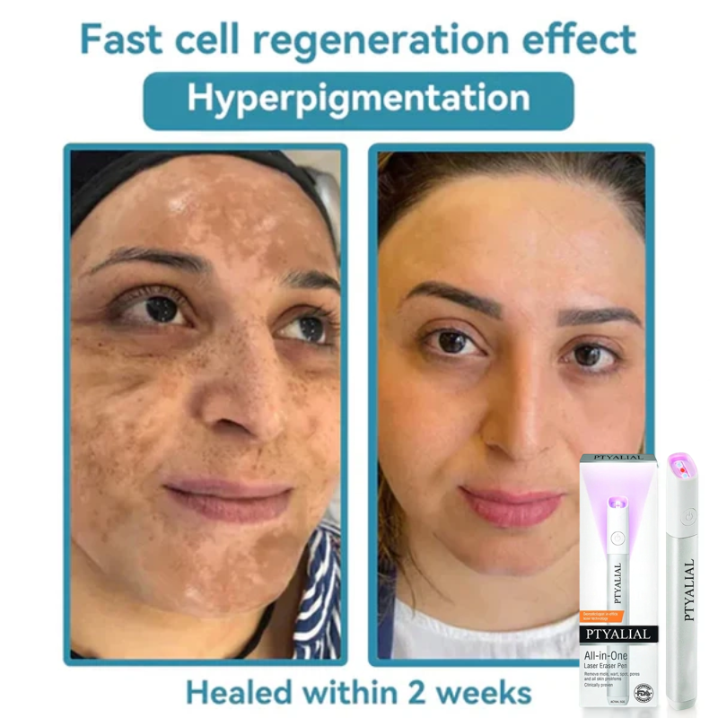 ✨Ptyalial™ All-in-One CO₂ Laser Eraser Pen | Removes Moles, Warts, Skin Flaws & Pigmentation